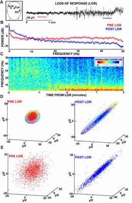 Remifentanil and Nitrous Oxide Anesthesia Produces a Unique Pattern of EEG Activity During Loss and Recovery of Response